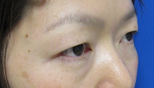 目の下のたるみ、目のくまでお悩みの方、切らずに完璧に解決します。TCB-R法　手術直後　症例写真